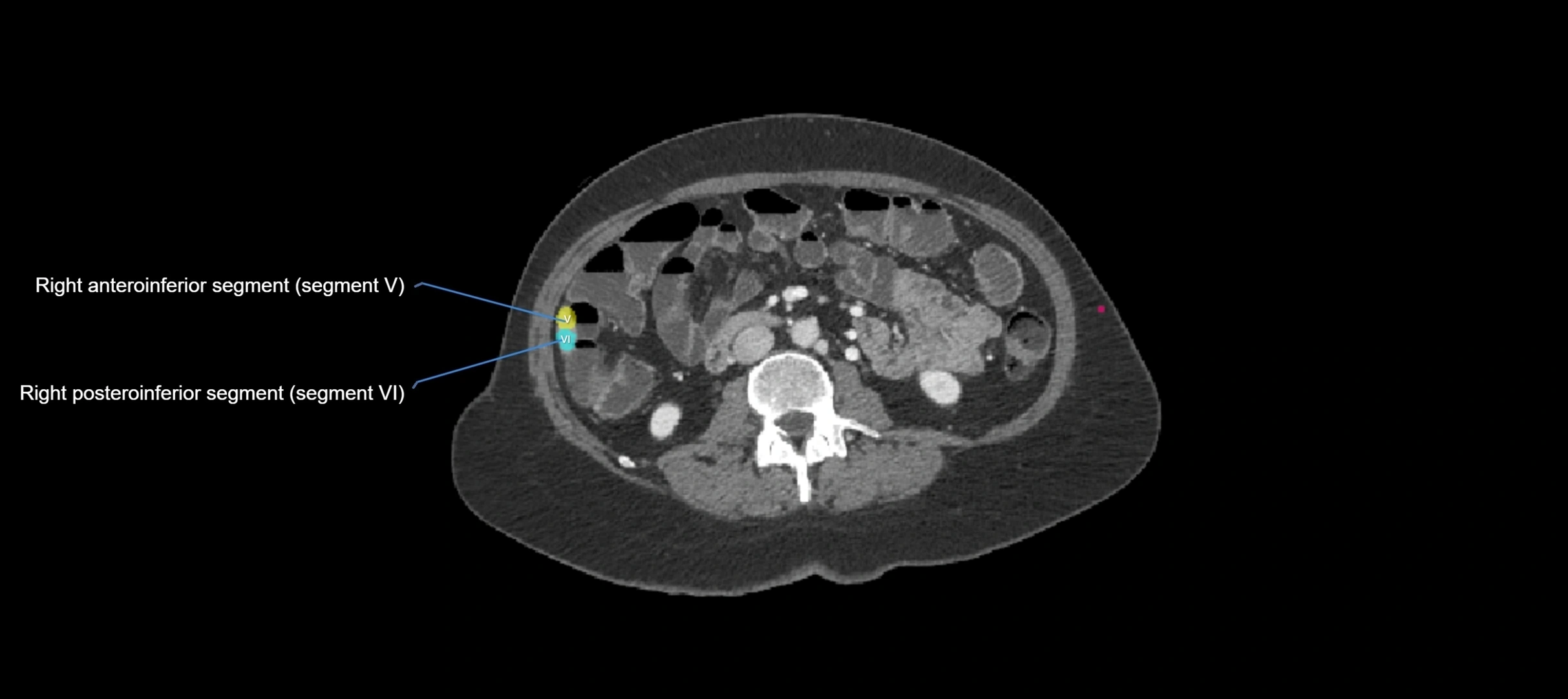 CT liver segments axial cross sectional anatomy labelled image-00002.webp